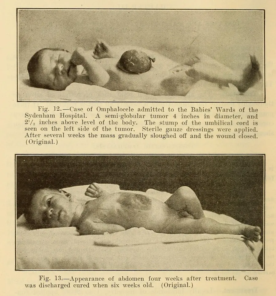 The Omphalocele card