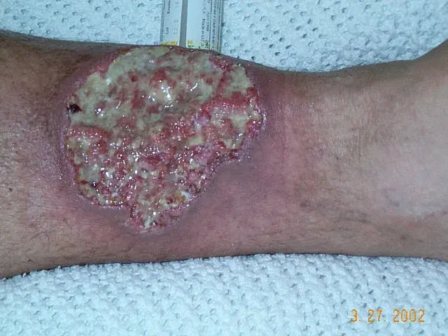 The Pyoderma gangrenosum card
