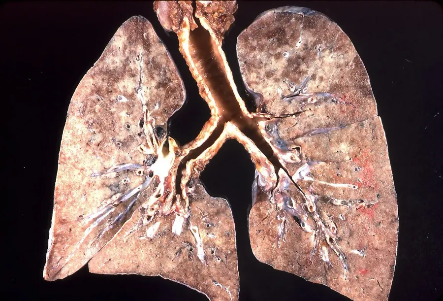The Pneumocystis pneumonia card