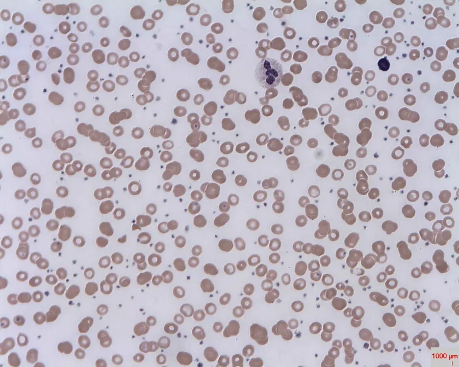 La carte Thrombocytose