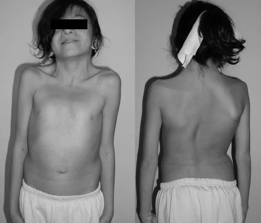 La carte Syndrome de Noonan