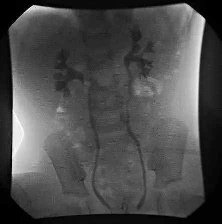 The Vesicoureteral reflux card