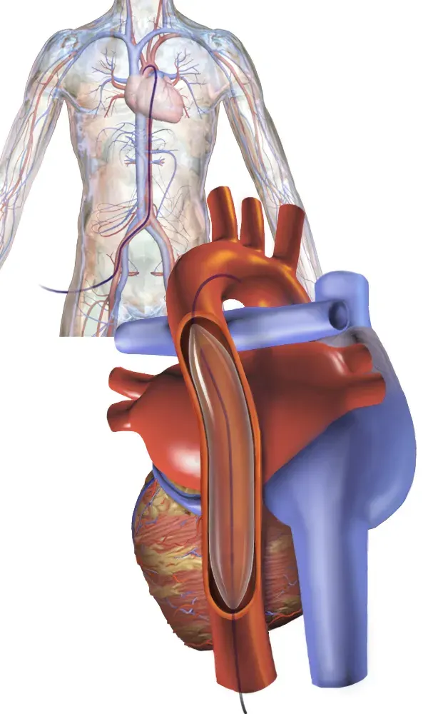 The Intra-aortic balloon pump card