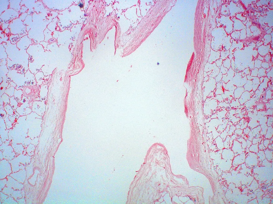 The Arteriovenous malformation card