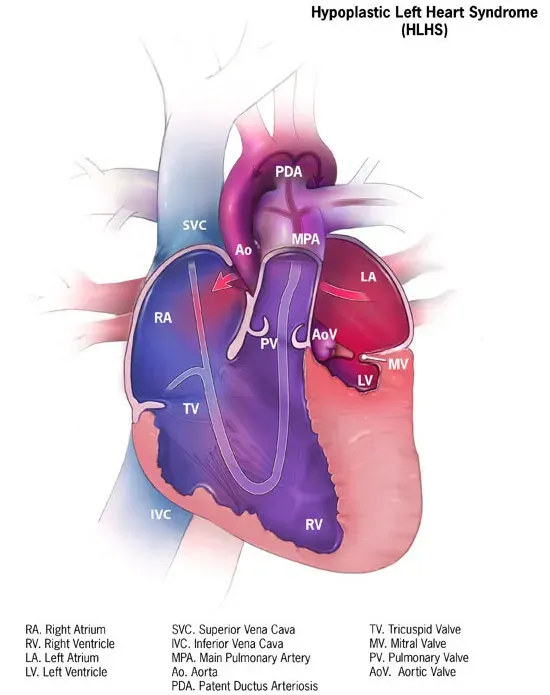 The Hypoplastic left heart syndrome card