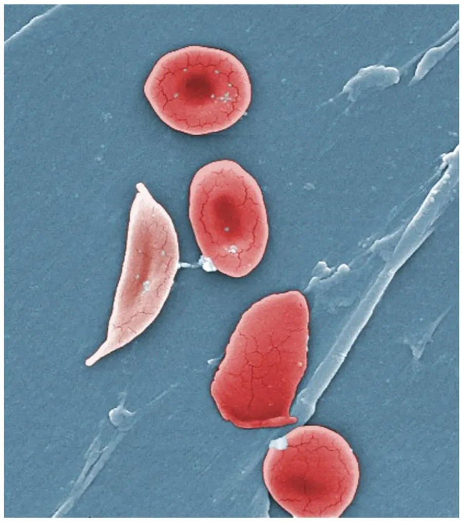 The Hemoglobinopathy card