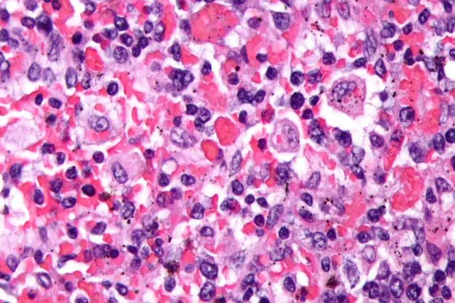 The Hemophagocytic lymphohistiocytosis card
