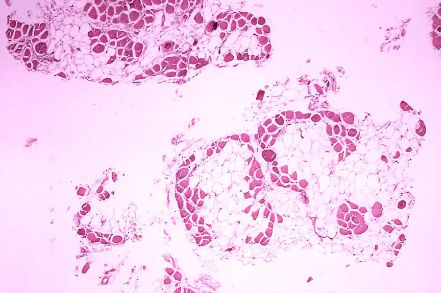 La carte Myopathie de Duchenne