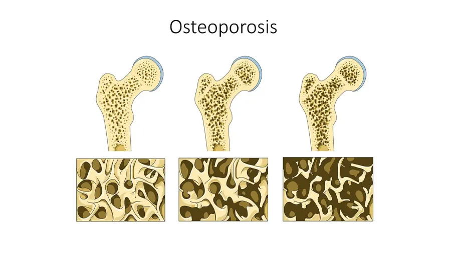 The Osteoporosis card