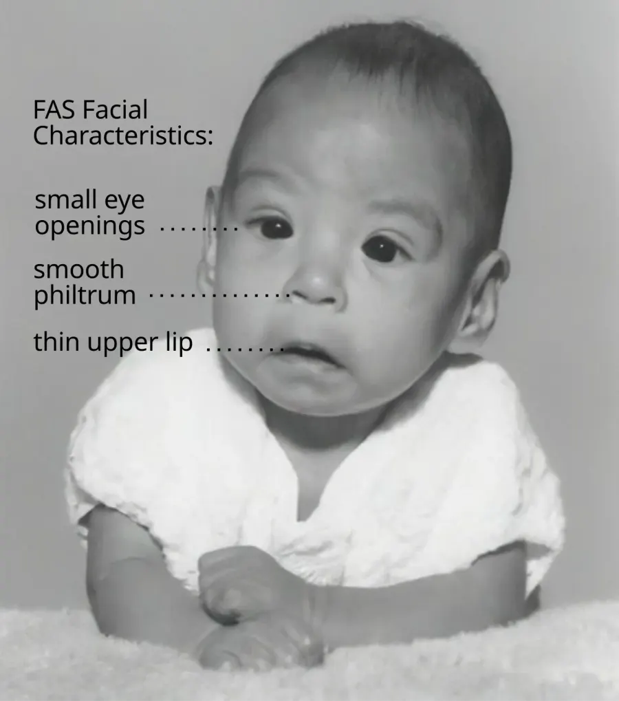 The Fetal alcohol spectrum disorder card