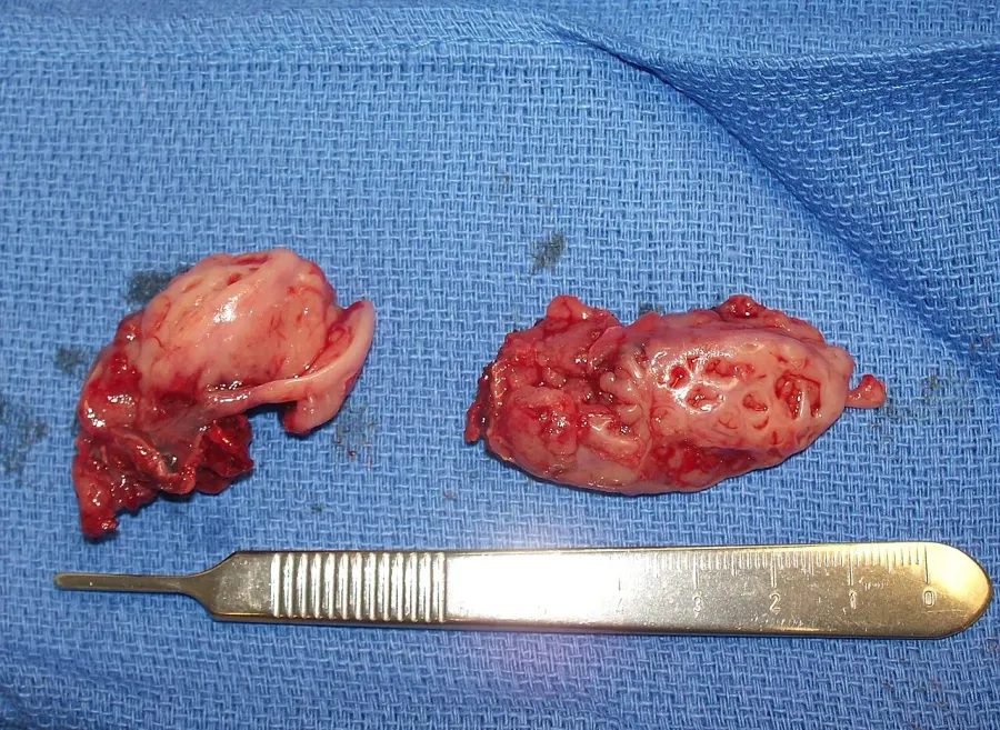 The Tonsillectomy card