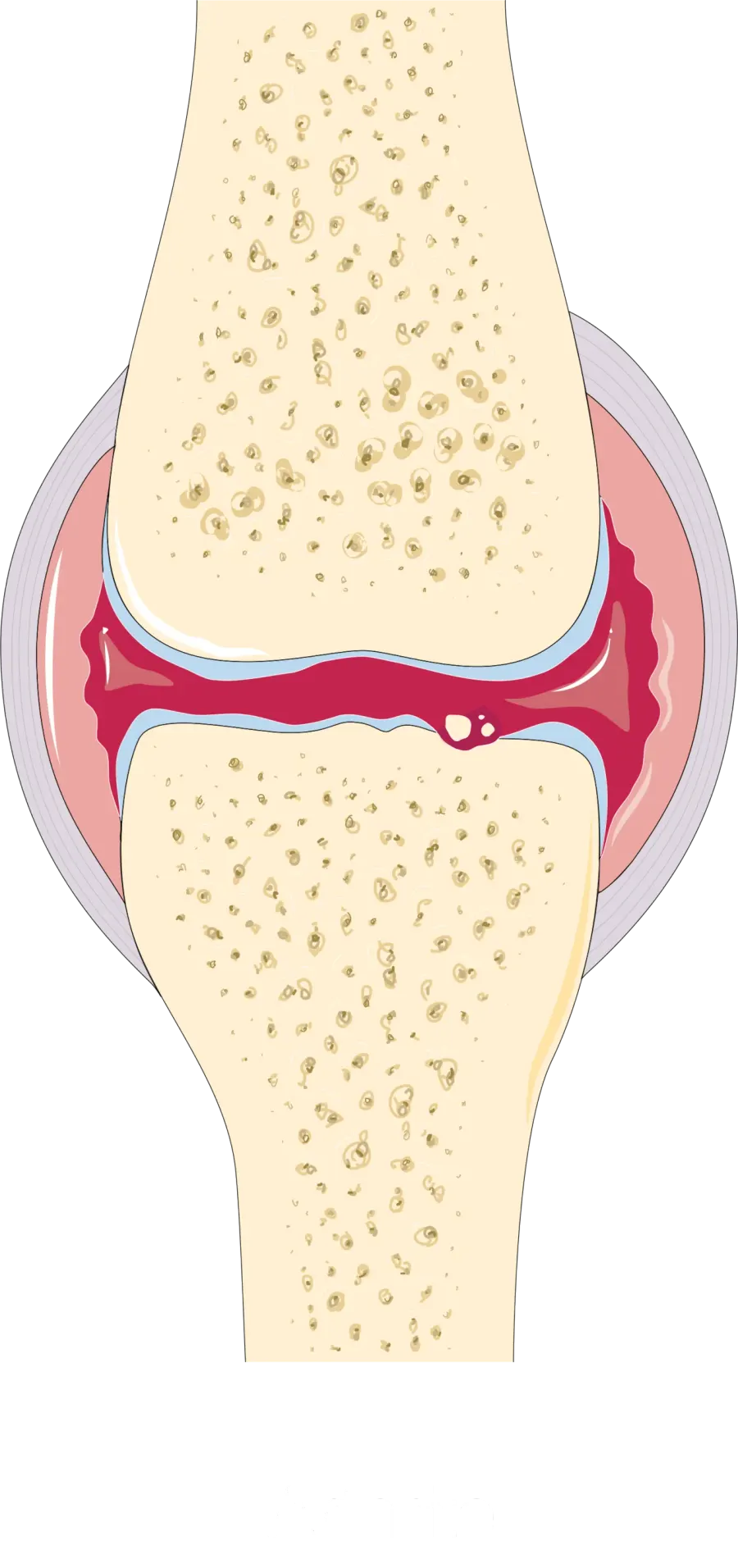 La carte Arthrite