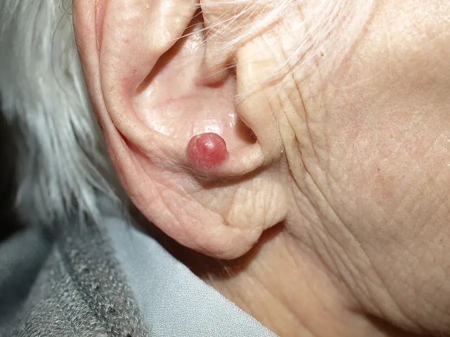 The Merkel-cell carcinoma card