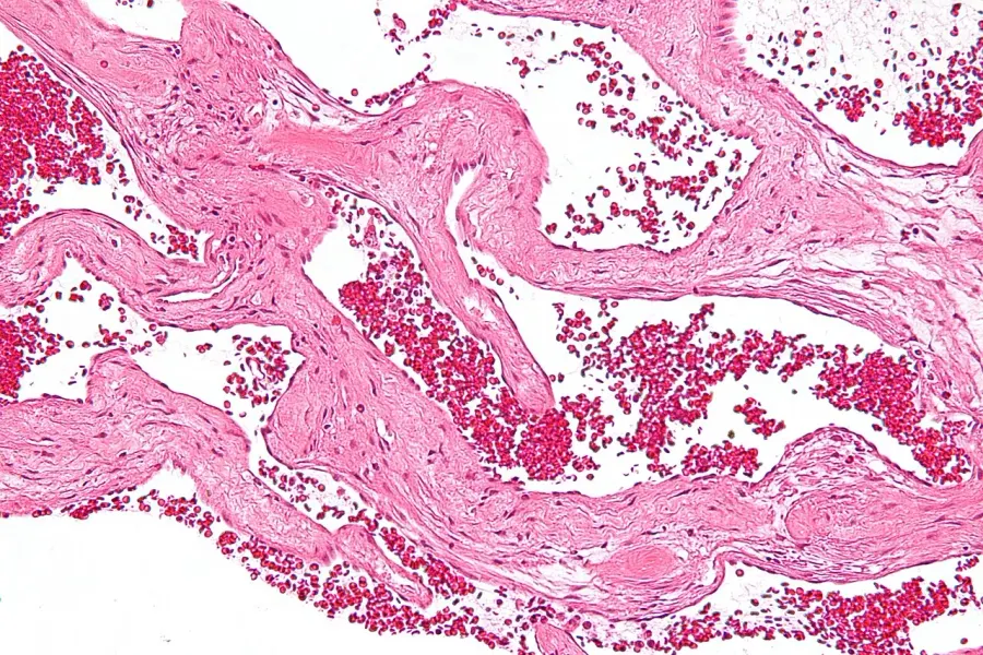 The Cavernous hemangioma card
