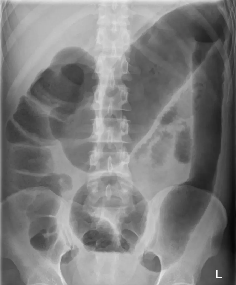 The Megacolon card