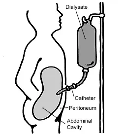 The Peritoneal dialysis card