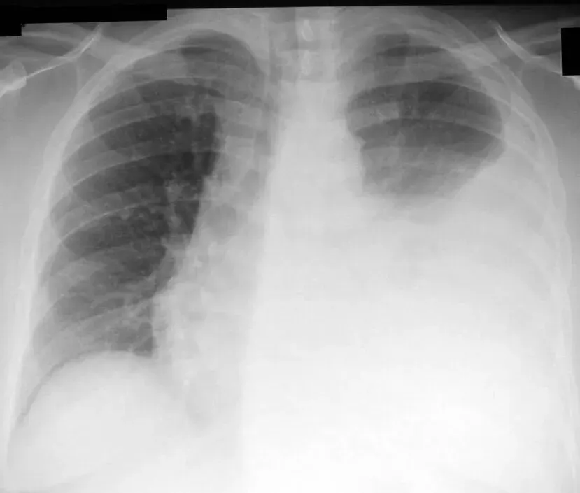 The Thoracentesis card