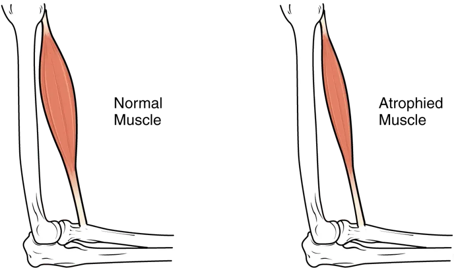 The Sarcopenia card