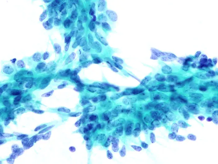 La carte Biopsie à l'aiguille fine
