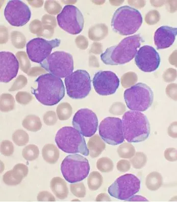 The Acute lymphoblastic leukemia card
