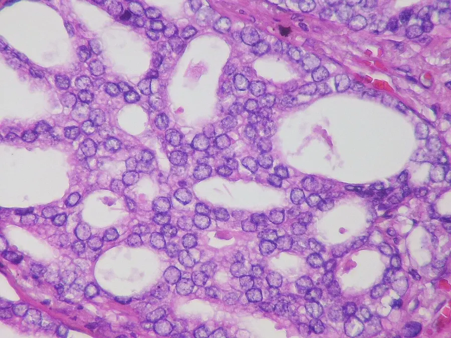 La carte Cancer de la prostate