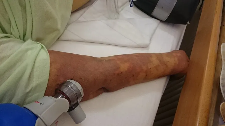 La carte Sepsis