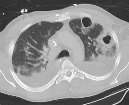 The Lung abscess card
