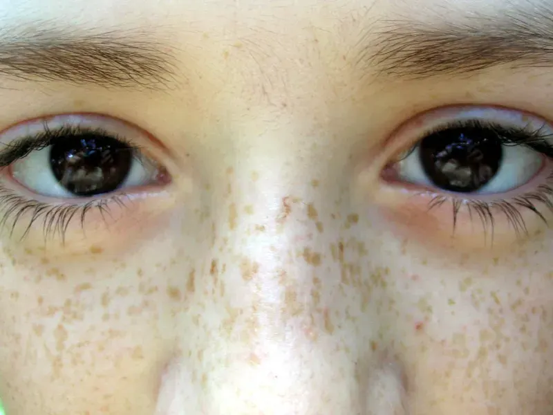 The Freckle card