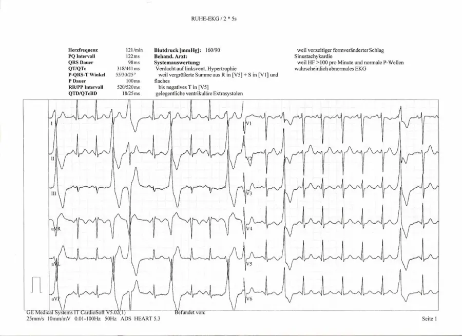 La carte Trouble du rythme cardiaque
