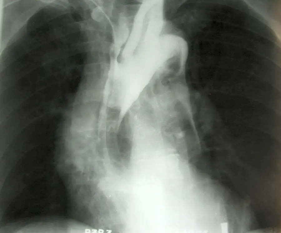 The Aneurysm card