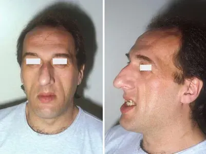 The Acromegaly card