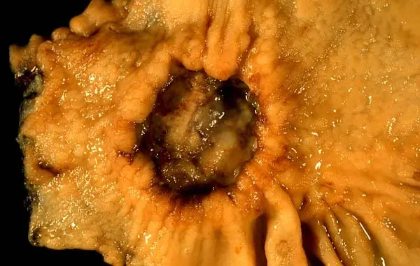 The Stomach cancer card