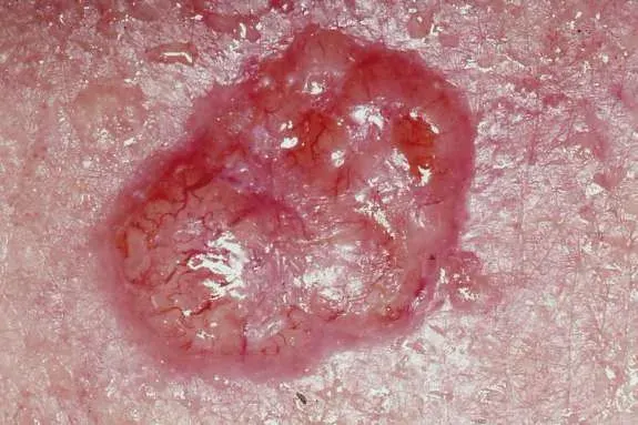 La carte Cancer de la peau
