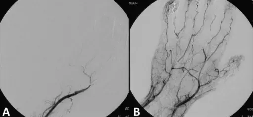 La carte Thrombolyse