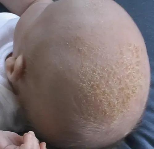 The Cradle cap card