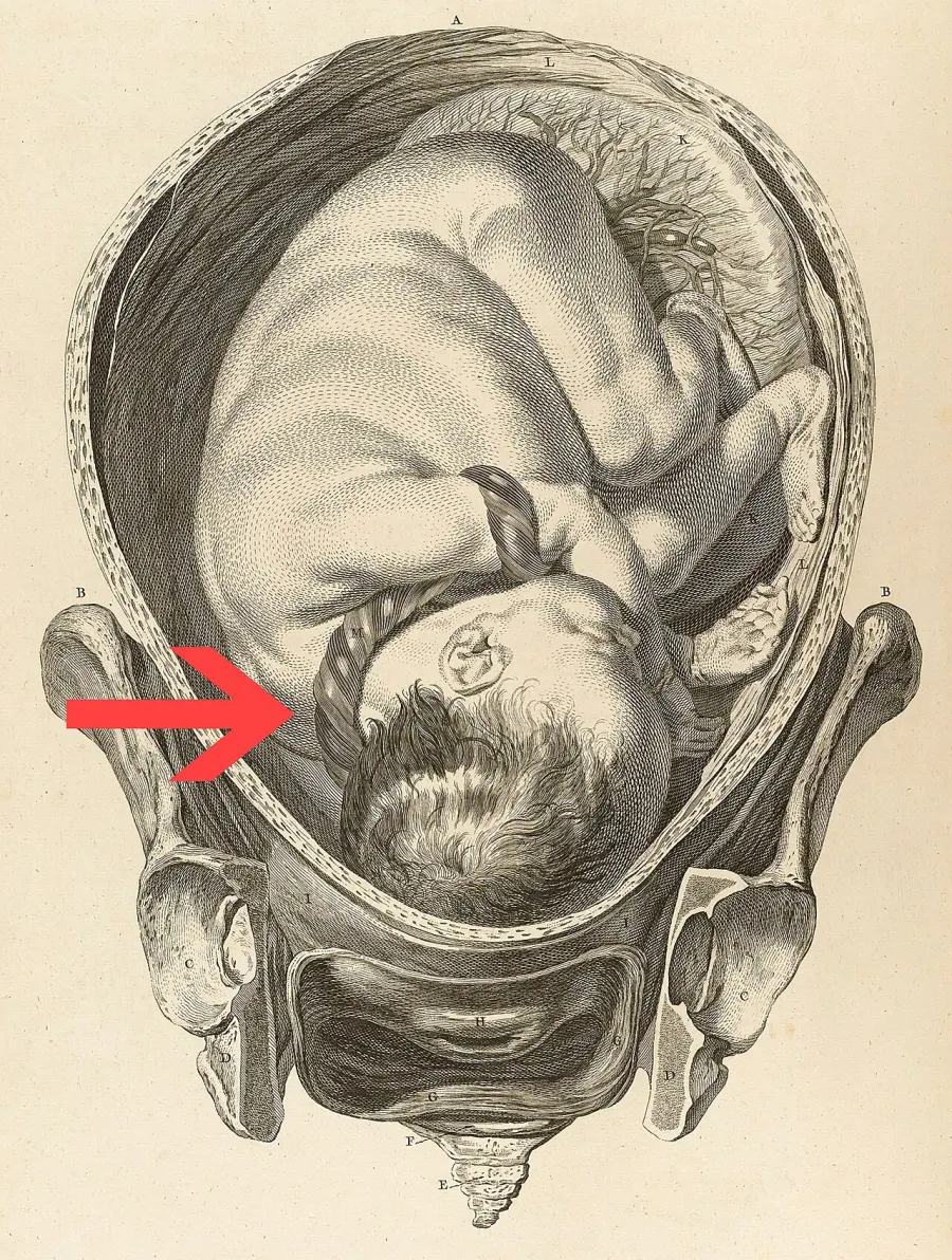 The Nuchal cord card