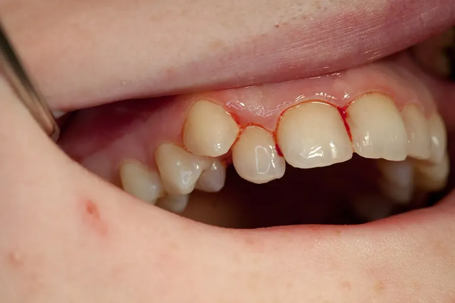 The Canine tooth card