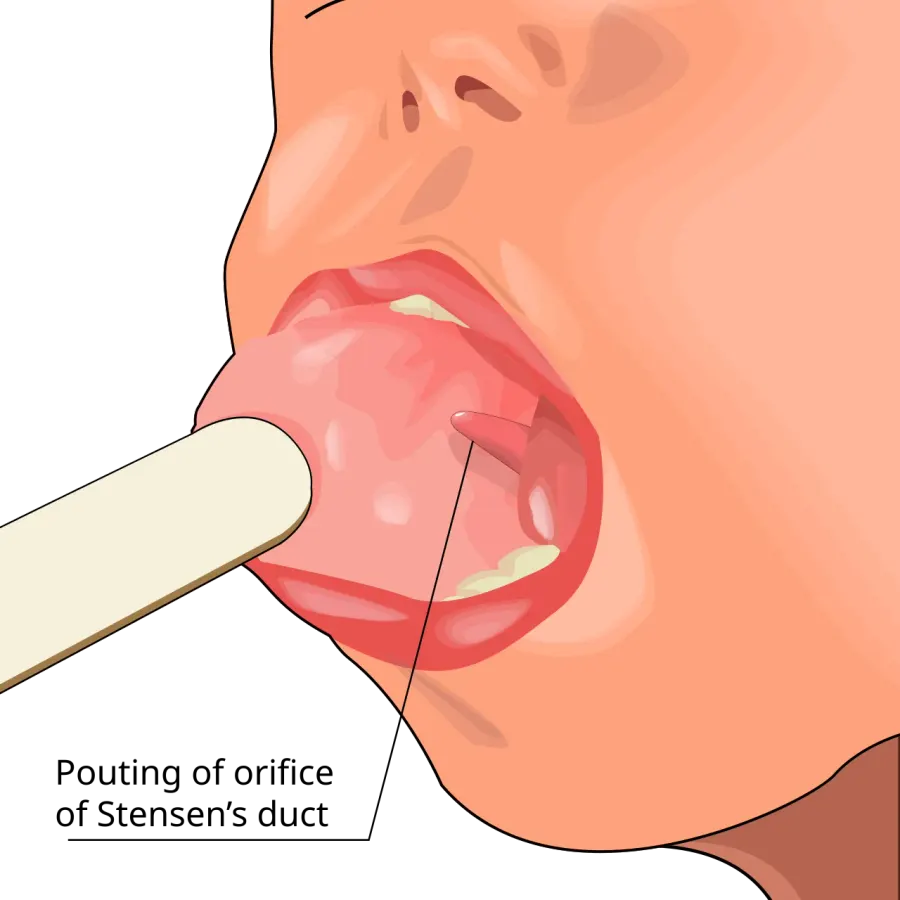 The Parotitis card