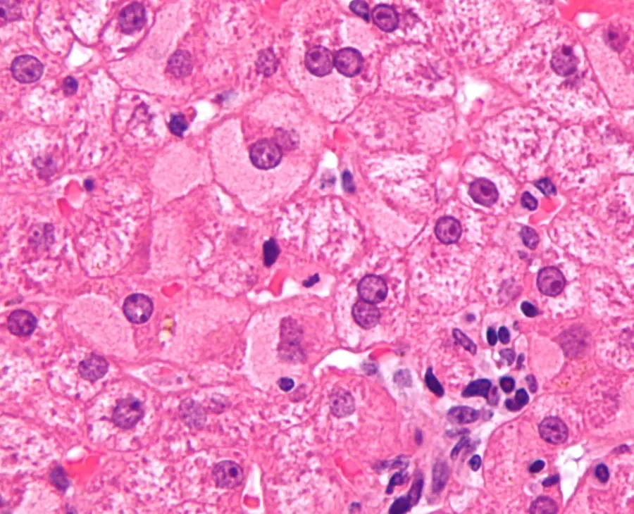 The Viral hepatitis card