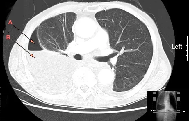 The Pleural empyema card