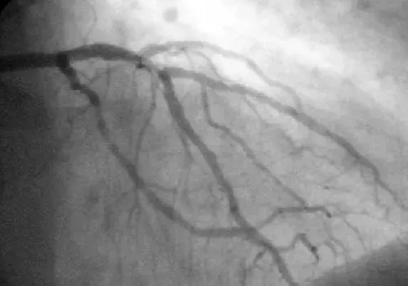 The Percutaneous coronary intervention card