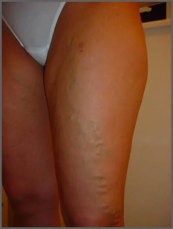 The Varicose veins card