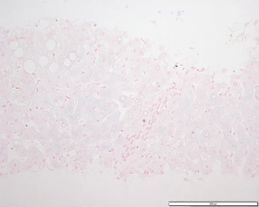 La carte Hémochromatose