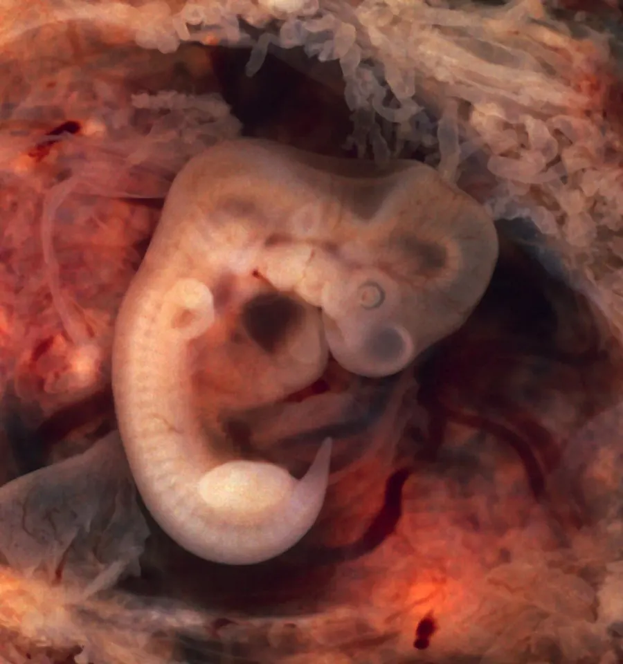 The Ectopic pregnancy card