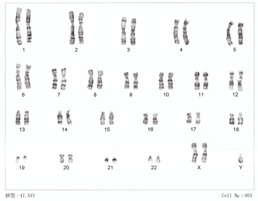 La carte Syndrome de Klinefelter