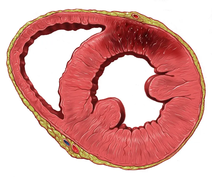 La carte Infarctus