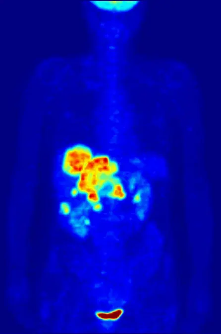 The Positron emission tomography card