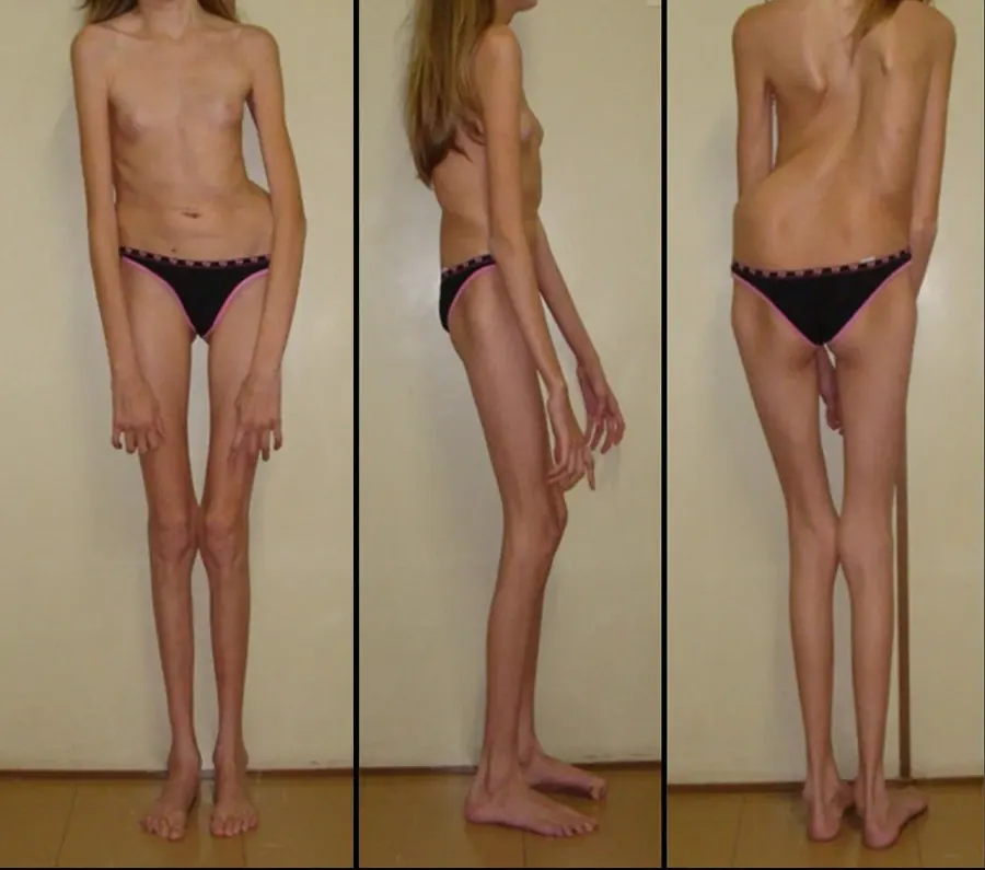 La carte Syndrome de Marfan