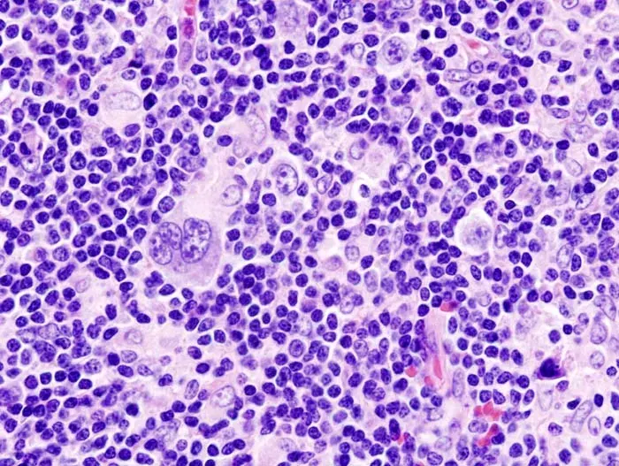 La carte Lymphome de Hodgkin