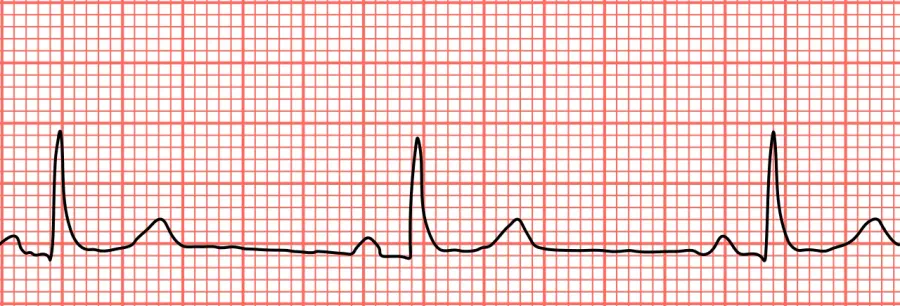 La carte Bradycardie